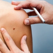 Extremadura afronta cada verano uno de los principales factores de riesgo para el cáncer de piel. / LP Extremadura afronta cada verano uno de los principales factores de riesgo para el cáncer de piel. / LP